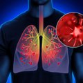 Kaip suprasti, kad peršalimas virto plaučių uždegimu: gydytoja išskyrė pavojingus požymius