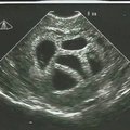 Privačios klinikos kritikuoja embrionų donorystės programą