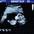 Pas gydytoją apsilankiusią nėščiąją pribloškė vaizdas echoskopo ekrane