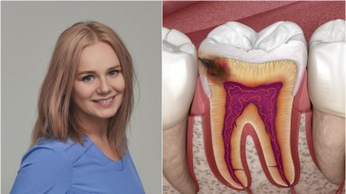 Odontologė patarė, kaip apsisaugoti nuo bakterijų, kurios sukelia kariesą: svarbi ir dantų pastos sudėtis
