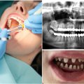 Vietoje spindinčios šypsenos – „ryklio“ dantys: lietuvė gailisi pasitikėjusi Turkijos klinika, įspėja ir kitus
