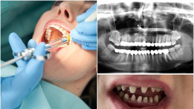 Vietoje spindinčios šypsenos – „ryklio“ dantys: lietuvė gailisi pasitikėjusi Turkijos klinika, įspėja ir kitus