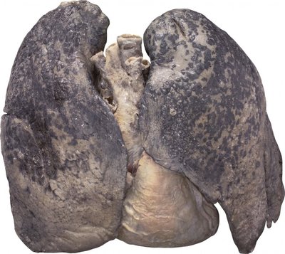 Rūkančio žmogaus plaučiai