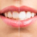 Išvardijo produktus, dėl kurių dantys praranda baltumą: patarė, kaip juos išbalinti patiems