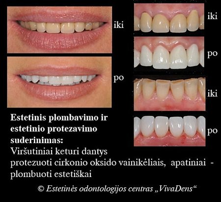 Estetinis protezavimas -plombų suderinimas