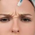 Moteris 20 metų reguliariai leidosi botoksą: nutraukusi injekcijas parodė, ką tai padarė su jos veidu