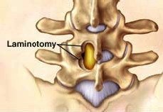 Vienpusė laminotomija