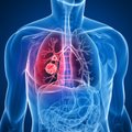 Išgyvena vis daugiau susirgusių plaučių vėžiu, tačiau liga – pavojinga