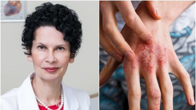 Gydytoja apie paplitusią lėtinę odos ligą, kurios negalima išgydyti: kai kurių sergančių vaikų tėvai netgi išvažiuoja gyventi į kitą šalį