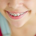 Dantų breketai ir plokštelės gali būti kompensuojami: nurodė žingsnius, ką daryti
