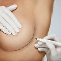 Krūtų didinimas – implantais ar savais riebalais?