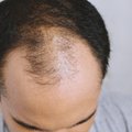 Naujovės medicinoje: gali padėti susigrąžinti plaukus galvos, antakių ir barzdos srityje