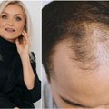 Mokslų daktarė Sandrija Čapkauskienė pasakė, ką būtina valgyti vyrams, kad neslinktų plaukai ir nenupliktų