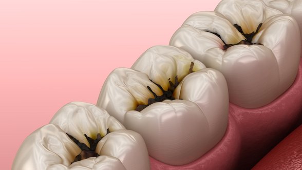 Kardiologė paaiškino, kaip dantys susiję su infarktu ir ką galime padaryti, kad jo išvengtume