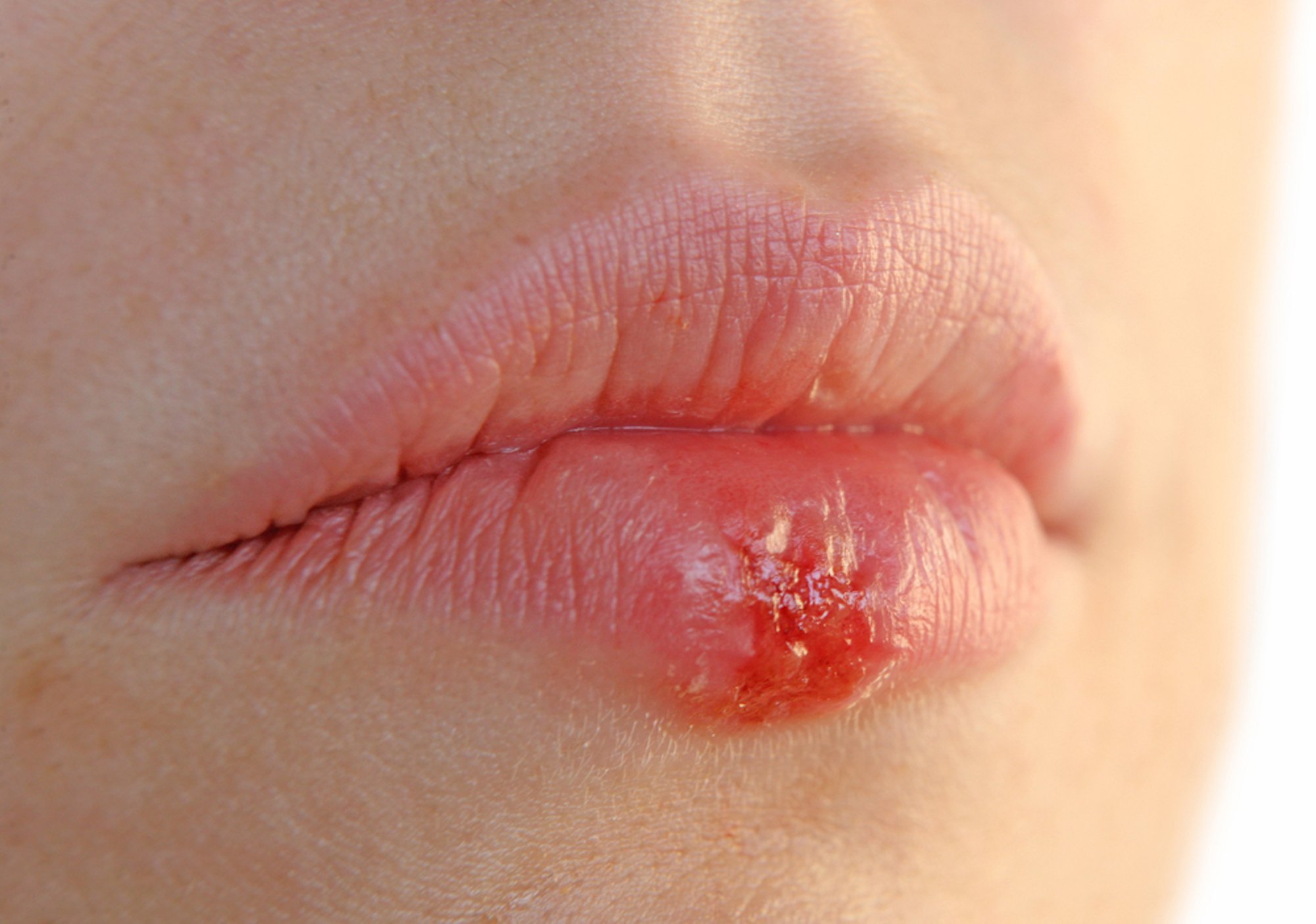 10 народных способов борьбы с простудой на губах - Delfi RU