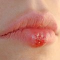 Herpes virusas kelia grėsmę gyvybei