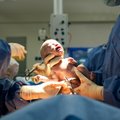 SAM: esant rizikos faktoriams gimdyvės galės prašyti cezario pjūvio operacijos