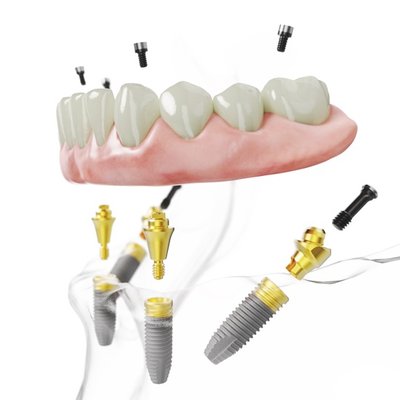 Naudojant All-on-4® gydymo metodiką visi vieno žandikaulio dantys atkuriami ant 4 implantų / „Nobel Biocare“ nuotr.