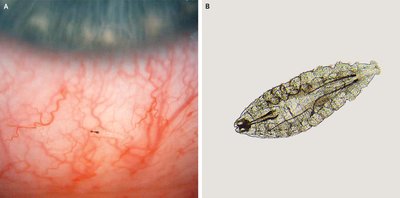 Aviniai gyliai prancūzui sukėlė akies uždegimą. Scanpix/Shutterstock/nejm.org nuotr.