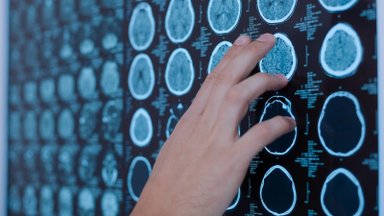 Medikė apie neinvazinį tyrimą: gali prireikti besiskundžiantiems galvos skausmu, svaigimu ar galūnių tirpimu