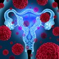 Onkoginekologė pasakė, kaip dažnai reikėtų lankytis pas gydytoją, norint išvengti gimdos kaklelio vėžio