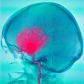 Septyni būdai kaip nustatyti smegenų aneurizmą, kol dar nevėlu