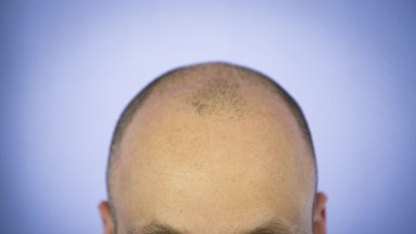 Plaukų slinkimas ir plikimas: kaip efektyviai gydyti ir kada apmokės valstybė, o už ką teks pačiam 