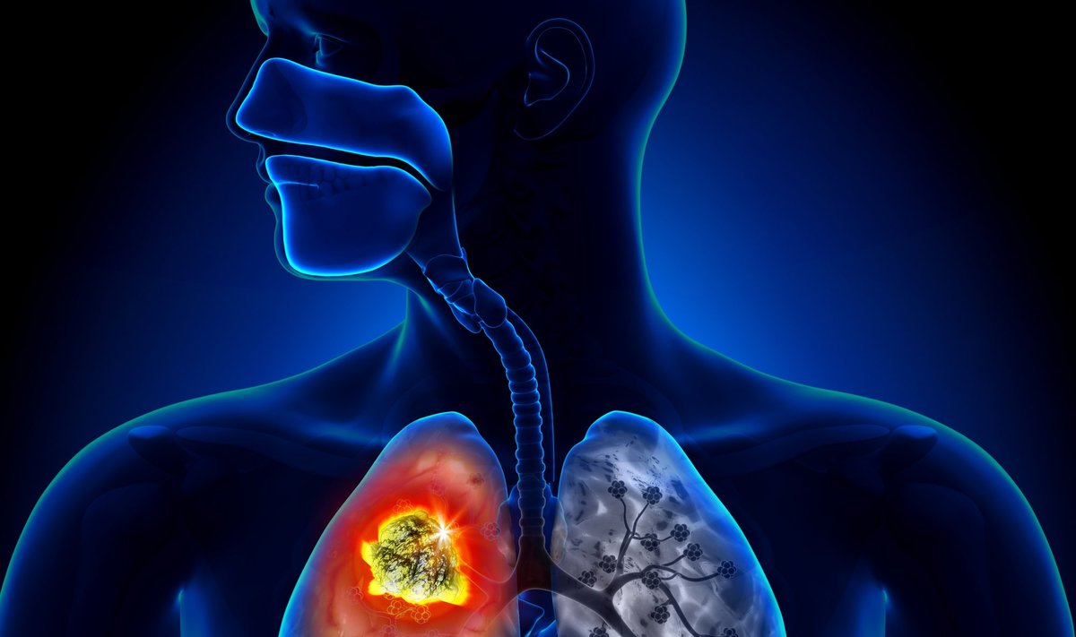 Plaučių vėžys