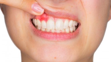 Kraujuojančios dantenos gali būti burnos ligos požymis: dažnas su tuo susidūręs daro didelę klaidą