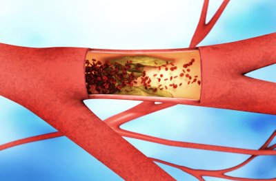 Periferinių arterijų liga