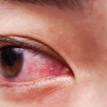 Sausos akys signalizuoja apie rimtą ligą