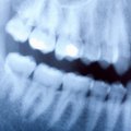 Tyrimas parodė, kad dantų rentgenogramos sukelia smegenų vėžį