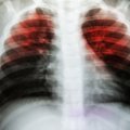 Galvoja – peršalimas, paaiškėja – tuberkuliozė: profesorius įvardijo pro akis praleidžiamus simptomus