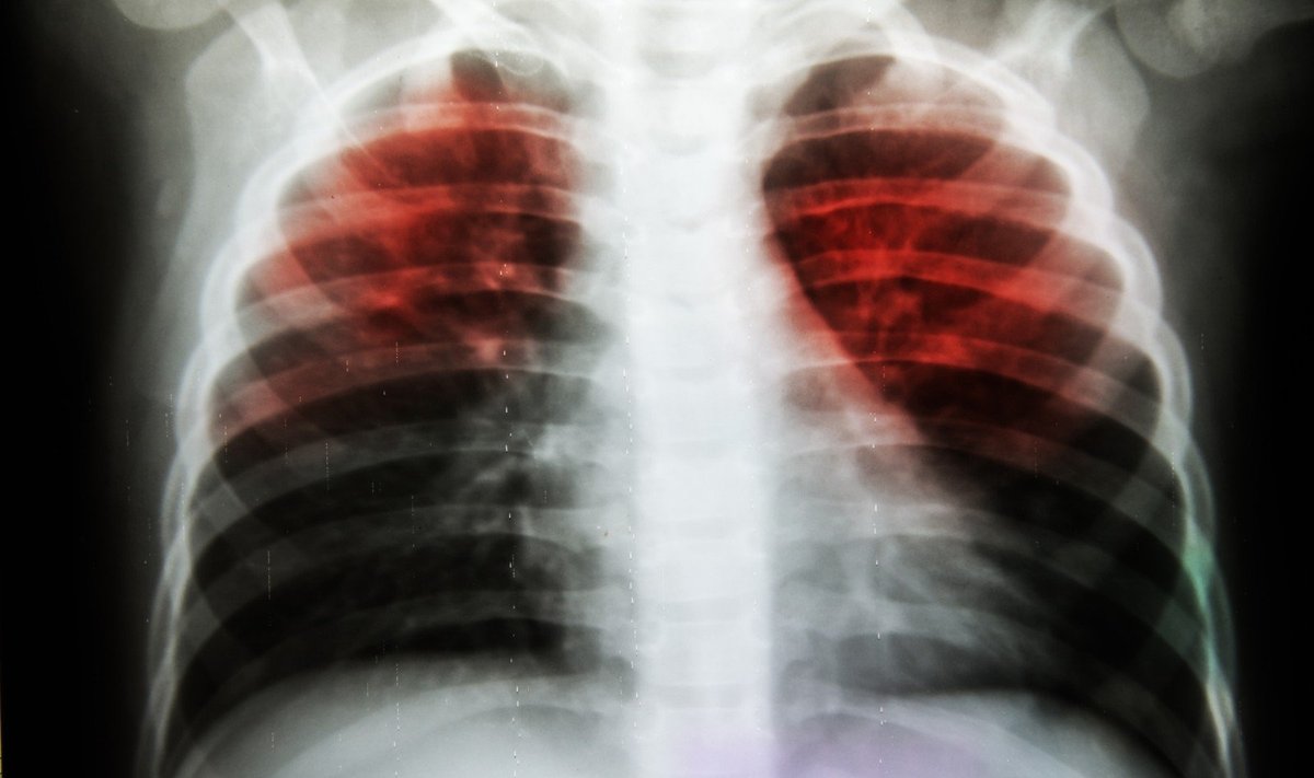 Tuberkuliozės pažeisti plaučiai