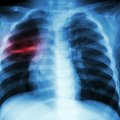 Atnaujinti Europos Sąjungos sergančiųjų tuberkulioze priežiūros standartai