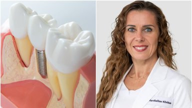 Kompensuojami implantai senjorams – gydytoja nurodė, ką svarbu žinoti, renkantis tokį dantų atkūrimą