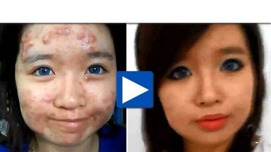 Девушка с акне, преобразившаяся с помощью макияжа, стала сенсацией