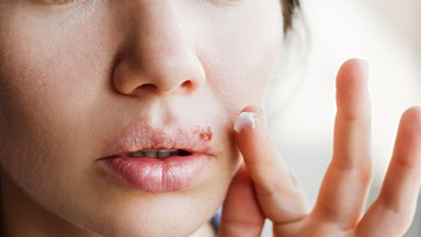 Lūpų pūslelinės komplikacija gali būti ypač grėsminga: kas padės greitai ir veiksmingai išgydyti šią ligą