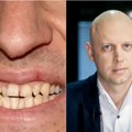 Odontologas įvardijo pagrindinę dantų netekimo priežastį: jos išvengti – labai paprasta