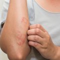 Neįprastas alergijos diagnostikos metodas: į moters odą buvo įleista jos vaikino spermos