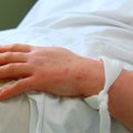 Mirtį sukelianti meningokoko infekcija: įmanoma išvengti daugelio atvejų