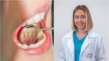 Kodėl vieniems žmonėms dantų akmenys susidaro greičiau nei kitiems: burnos higienistė išvardijo pagrindines priežastis