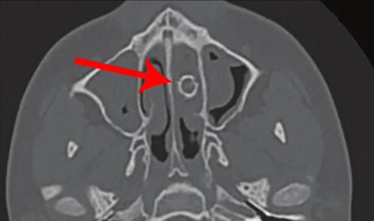 Paciento nosies rentgeno nuotrauka