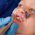 Kai kuriems vaikams dantys pradeda gesti anksčiau, o ėduonis pasireiškia dažniau: kas tai lemia?