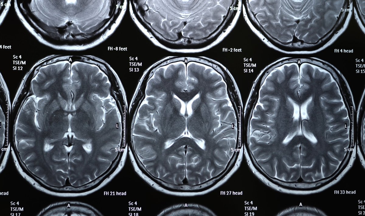 Persirgus COVID-19 stebimi pokyčiai smegenyse. Shutterstock/NIAID nuotr.