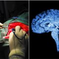 Eksperimento metu smegenyse implantuoti jutikliai nuskaitė neįgalaus vyro mintis: pasiektas beveik 100 proc. tikslumas