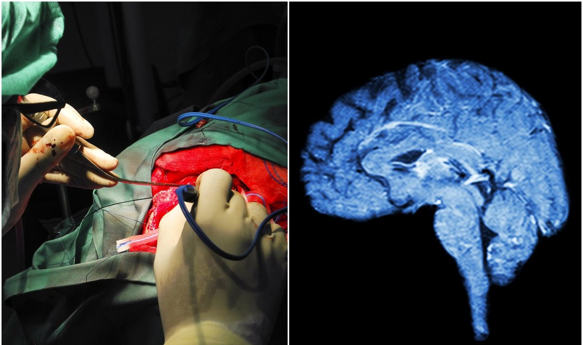 „BrainGate“ projekto mokslininkai į T5 smegenis sumontavo specialius jutiklius, galinčius skaityti signalus už motoriką atsakinguose centruose.