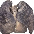 Dažnai plaučių donorais tampa rūkaliai