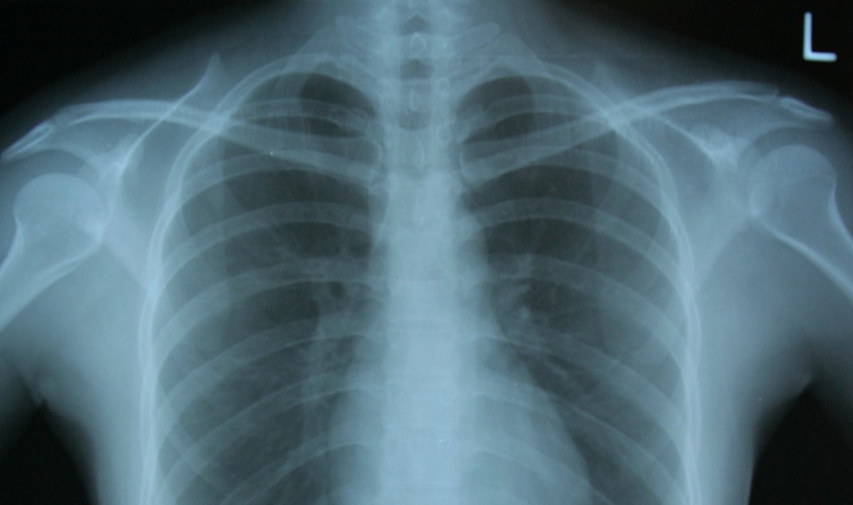 Krūtinės rentgenograma
