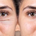 Sparčiai populiarėja akių vokų plastikos operacijos: ryžtasi ne tik dėl grožio, bet ir dėl sveikatos